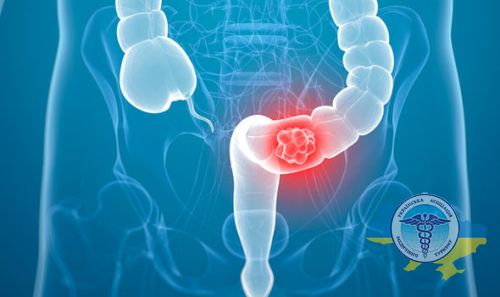 Рак кишечника